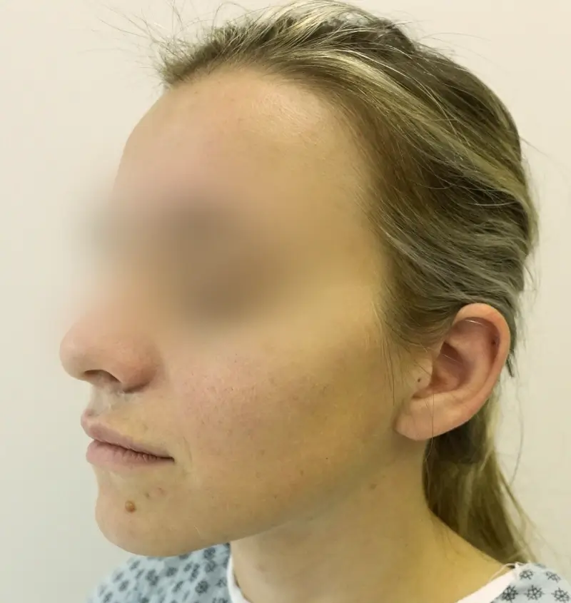 before and after otoplasty angle view