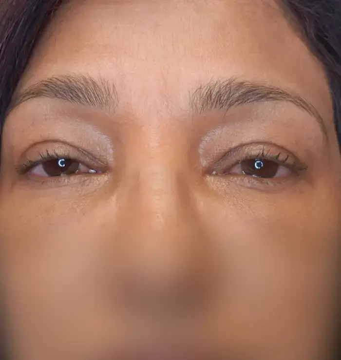before and after blepharoplasty front view
