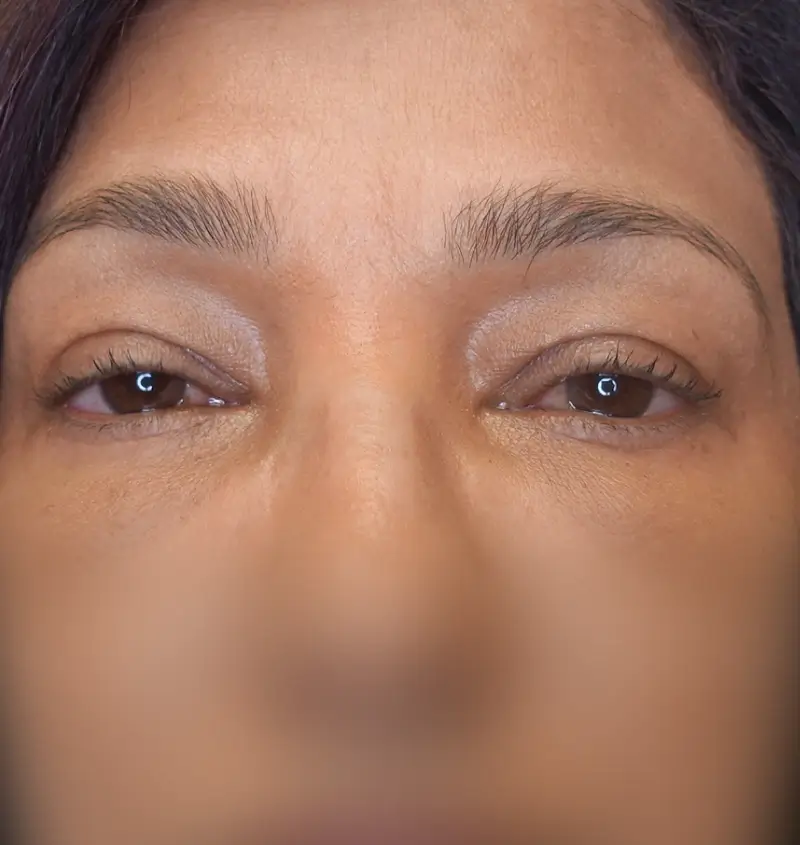 before and after blepharoplasty front view