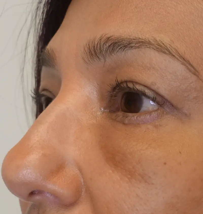 before and after blepharoplasty angle view