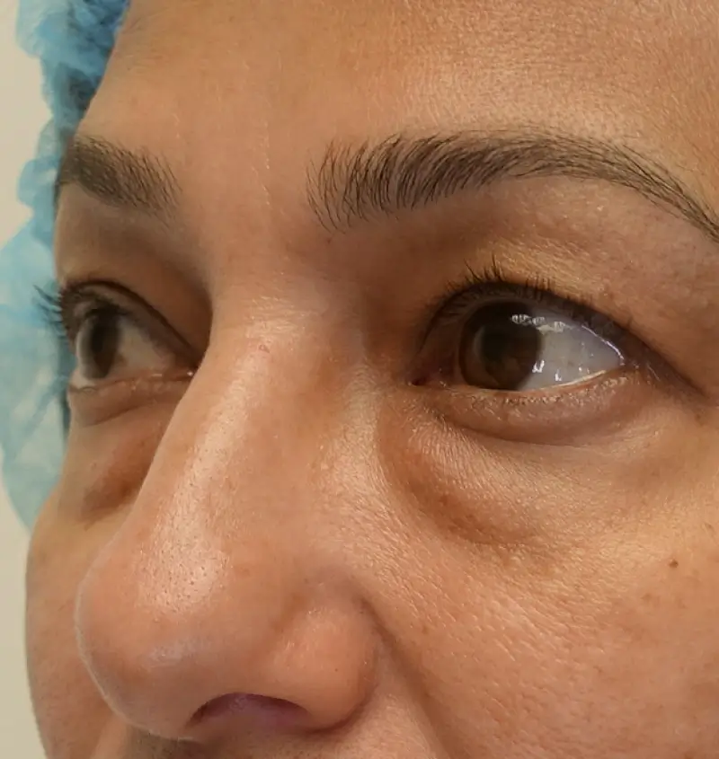 before and after blepharoplasty angle view