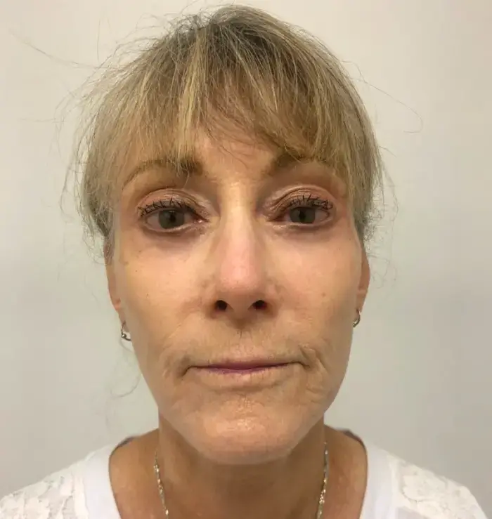 before and after facelift front view