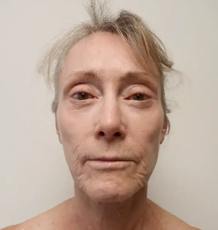 before and after facelift front view