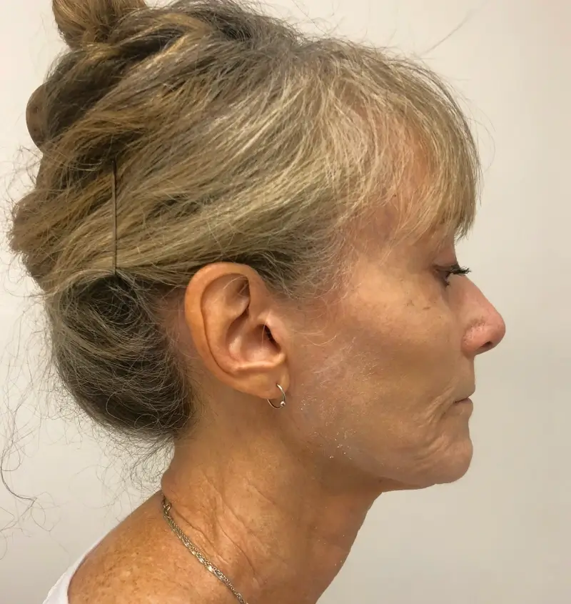 before and after facelift side view