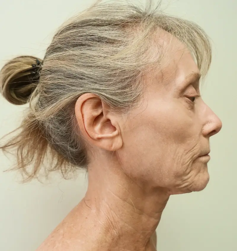 before and after facelift side view
