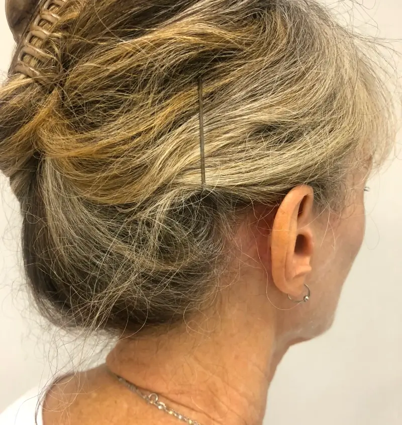 before and after facelift angle view