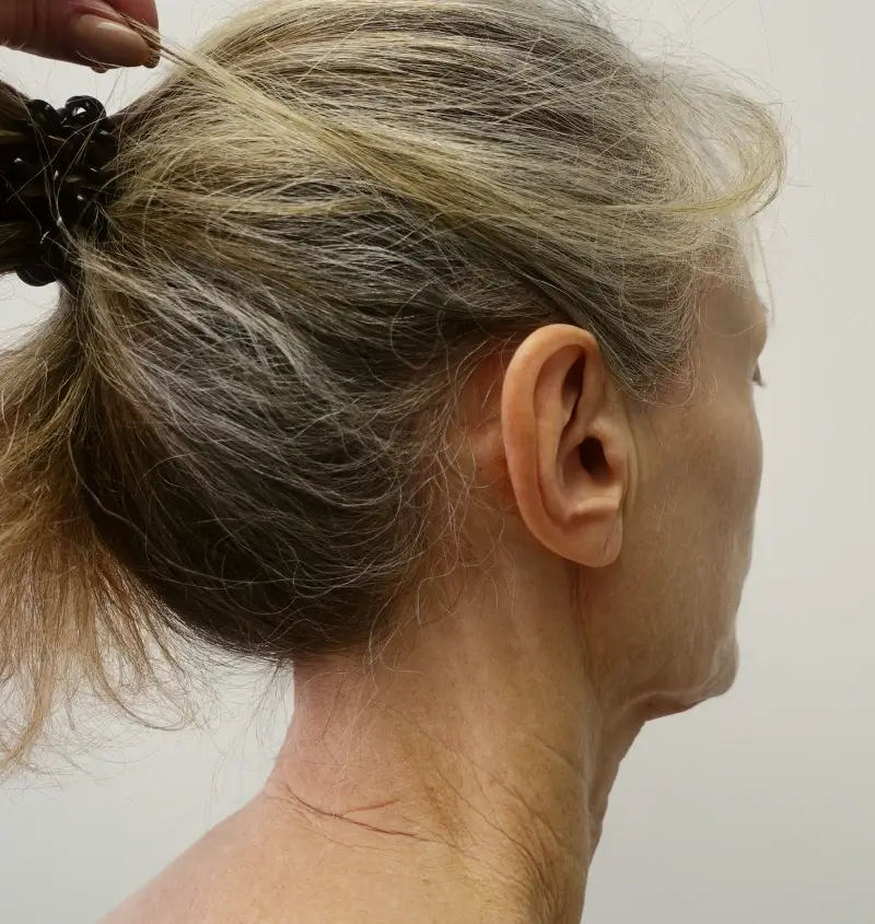 before and after facelift angle view