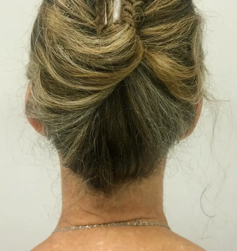 before and after facelift back view