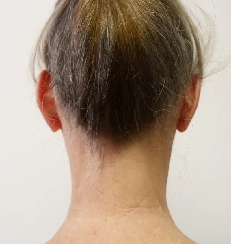 before and after facelift back view