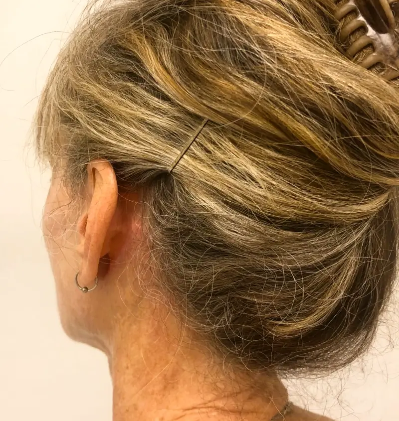 before and after facelift angle view