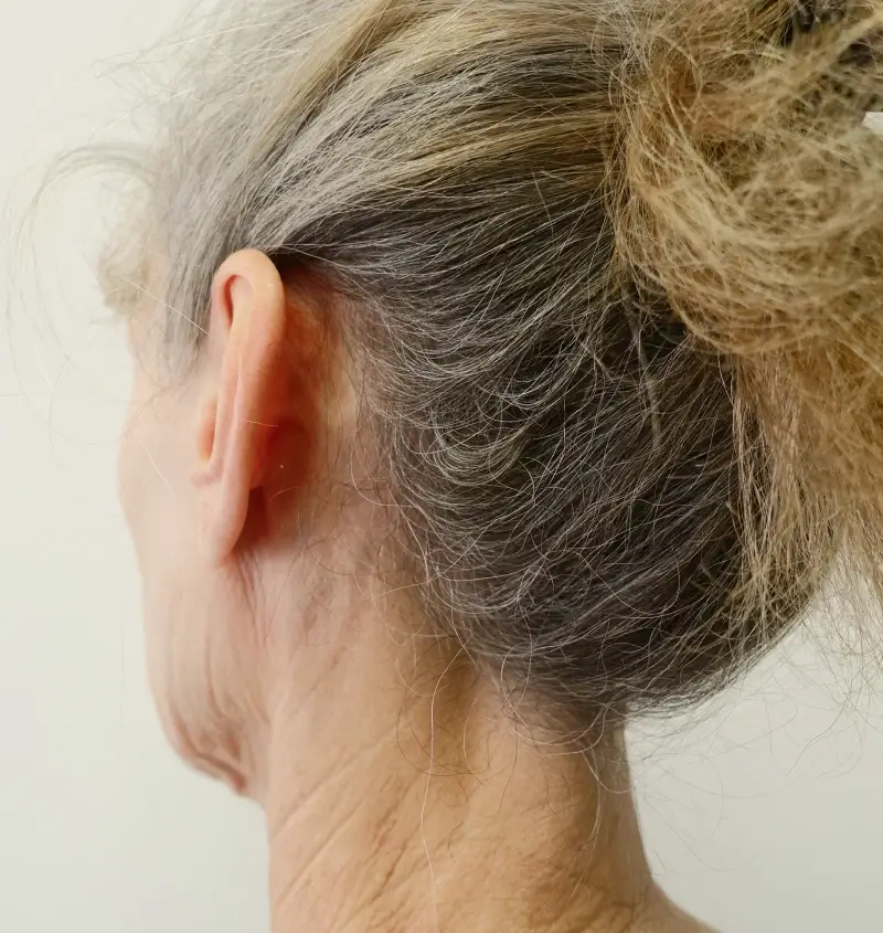 before and after facelift angle view