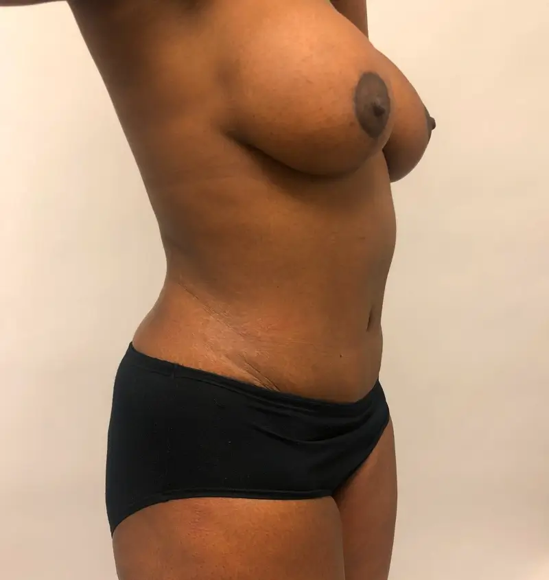 before and after mommy makeover angle view