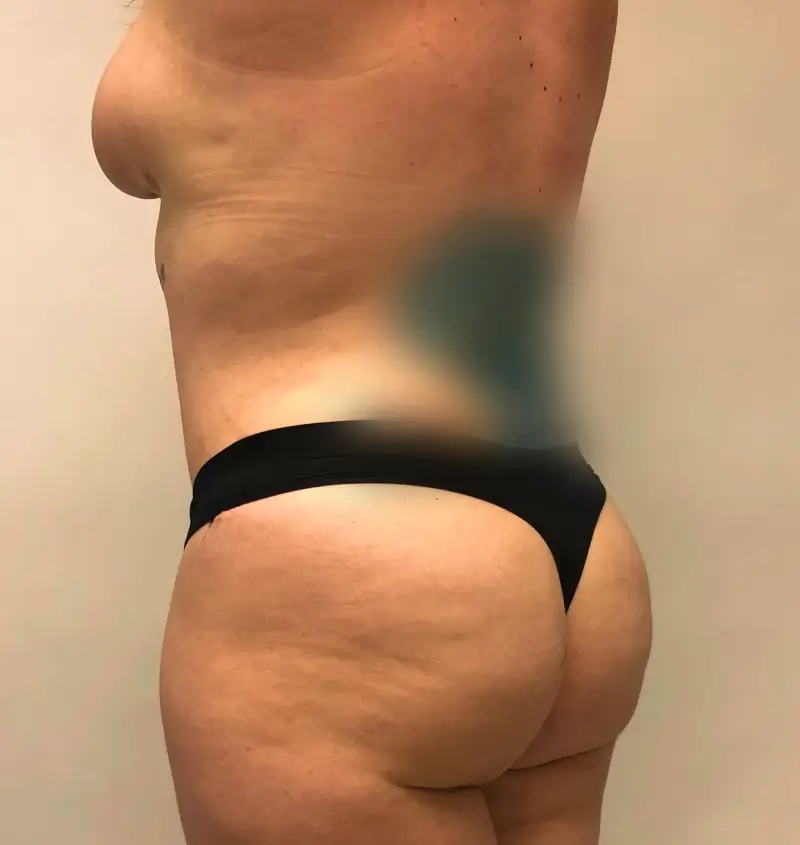 before and after mommy makeover side view