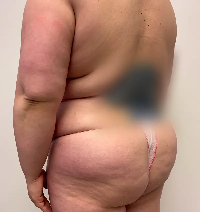 before and after mommy makeover angle view