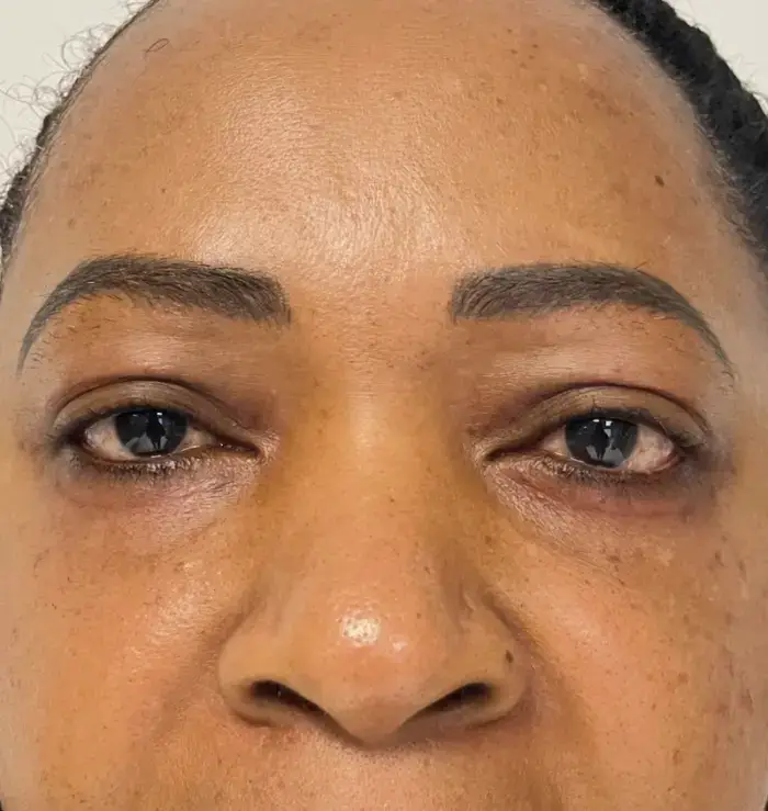 before and after blepharoplasty front view
