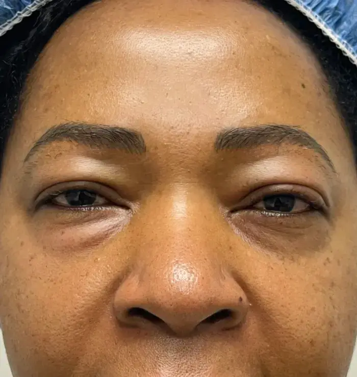 before and after blepharoplasty front view