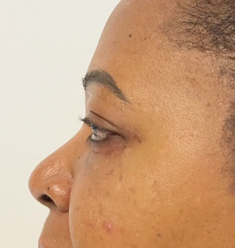 before and after blepharoplasty side view