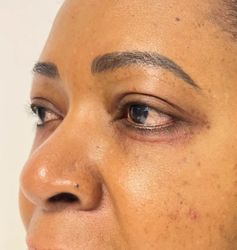 before and after blepharoplasty angle view