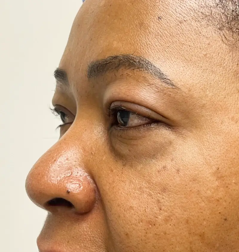 before and after blepharoplasty sideview
