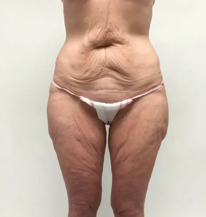 before and after tummy tuck front view