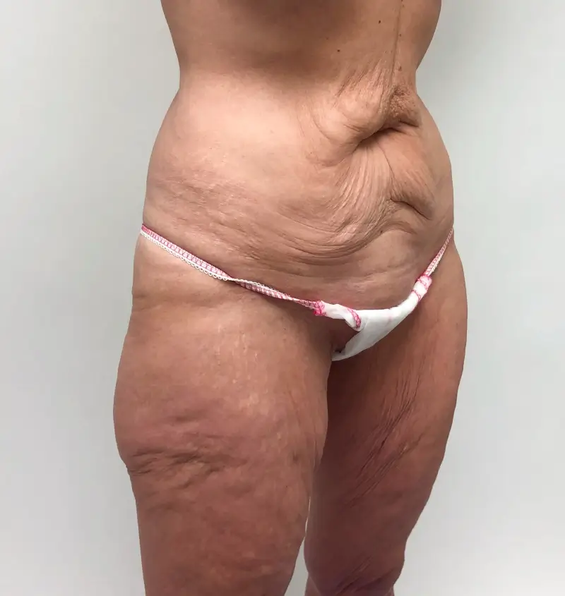 before and after tummy tuck angle view