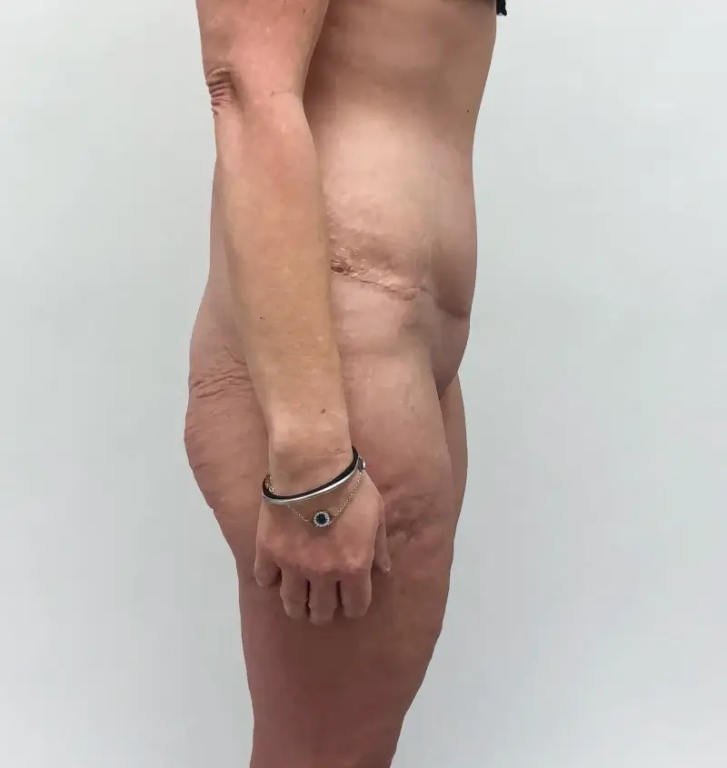 before and after tummy tuck side view