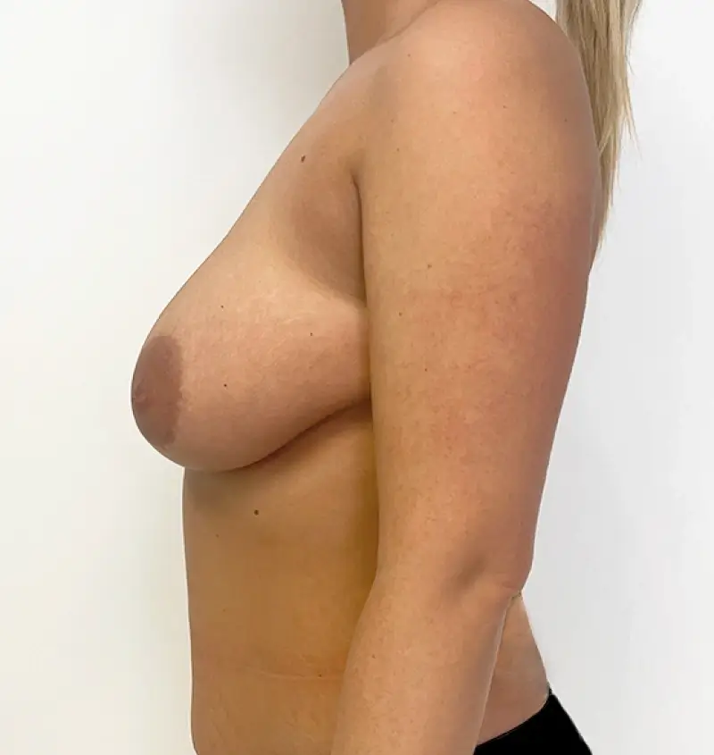 Before and after breast reduction side view