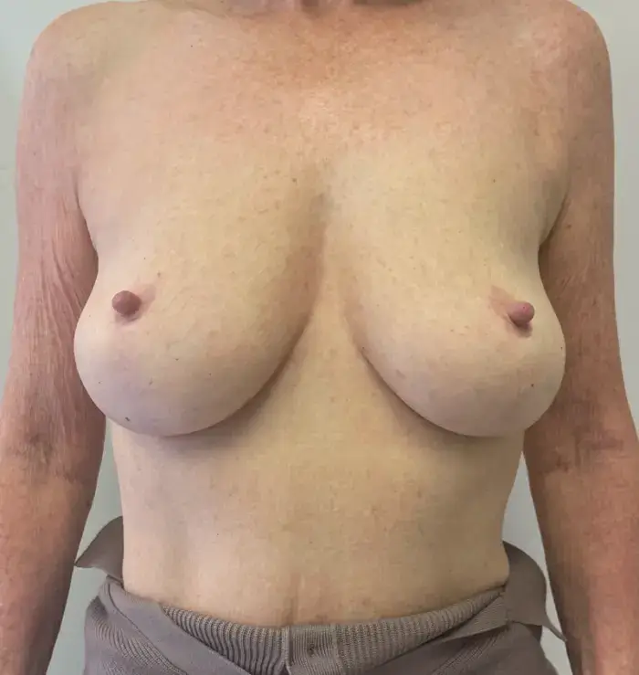 Before and after breast lift front view