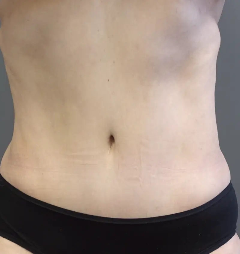 Before and after Tummy Tuck front view