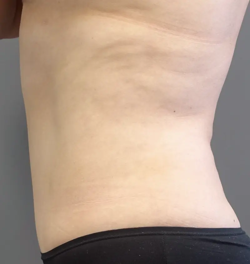 Before and after Tummy Tuck side view