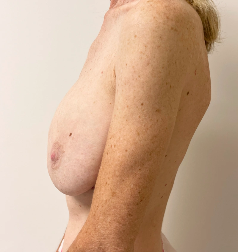 breast revision before and after side image