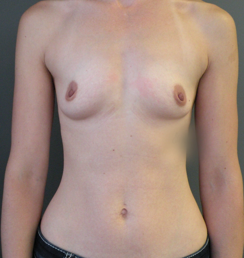 Before - Breast augmentation