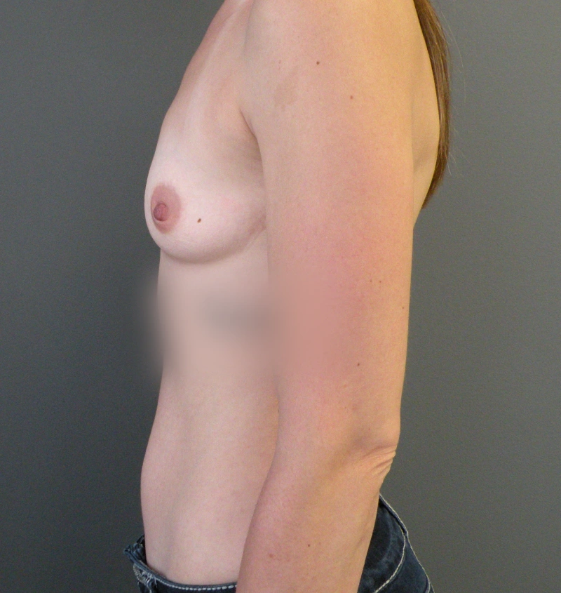 Breast augmentation results side profile