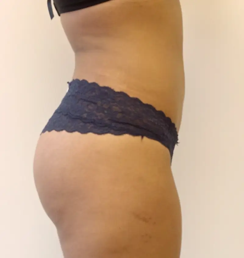 Before and after BBL side view