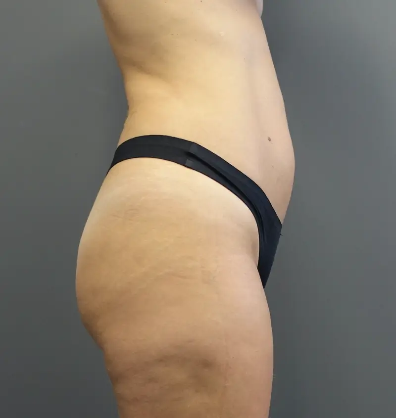 Before and after BBL side view
