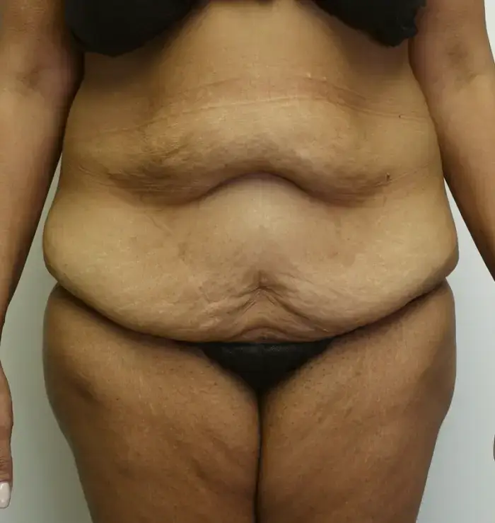 Before and after Tummy Tuck front view