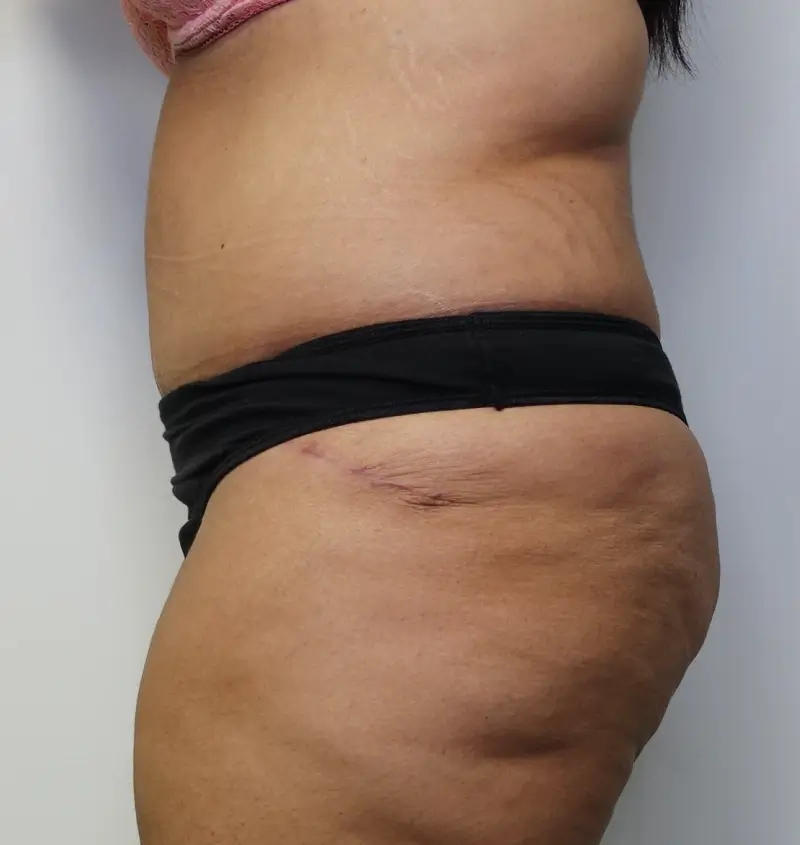 Before and after Tummy Tuck side view