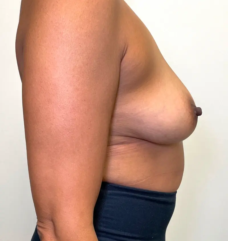 Breast implant removal before and after side