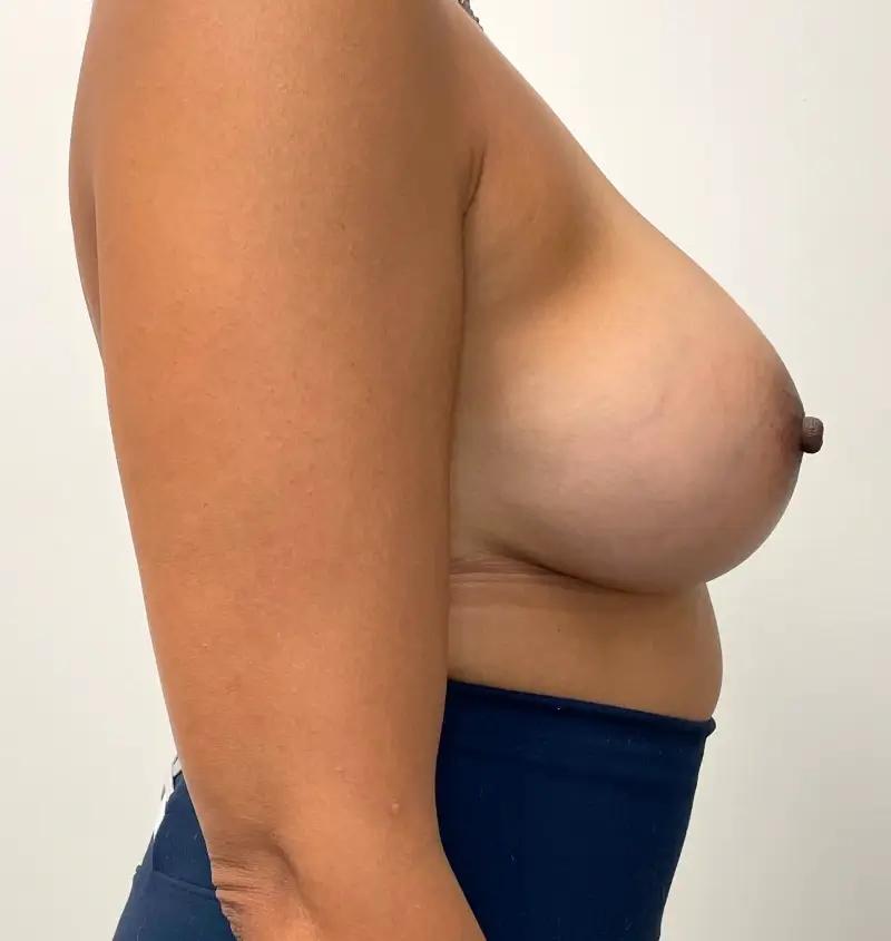 Breast implant removal before and after side