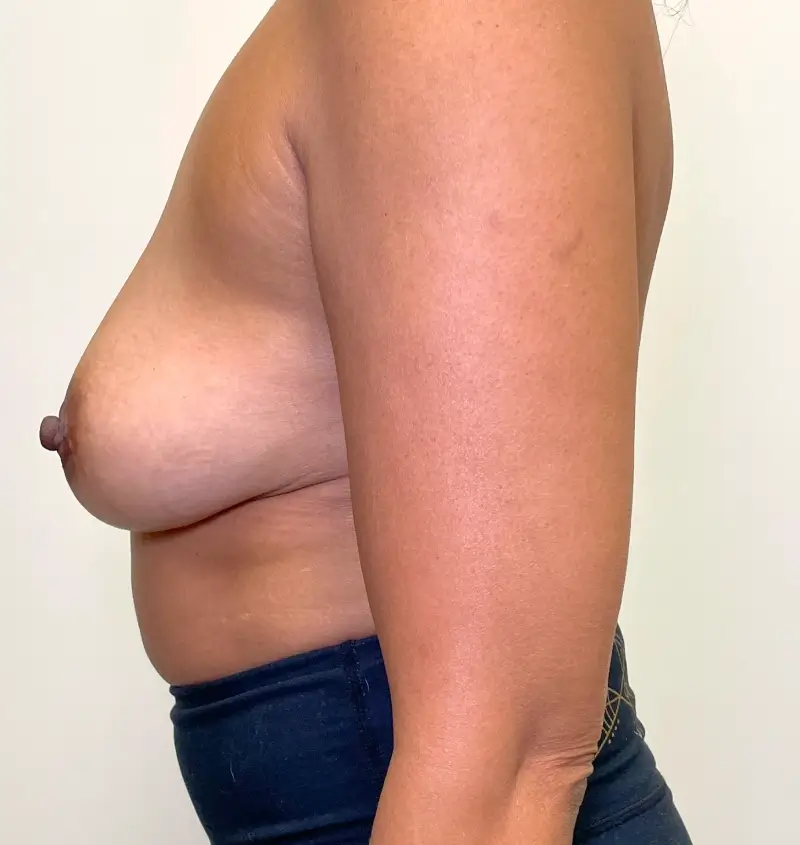 Breast implant removal before and after side