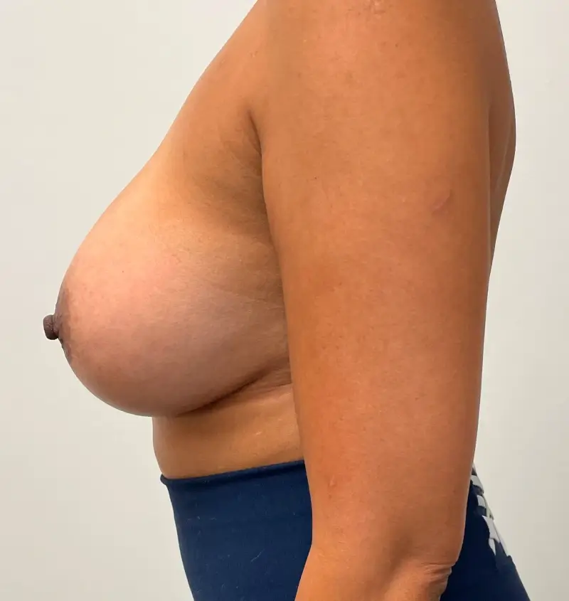 Breast implant removal before and after side