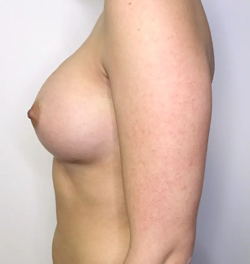 Before and after of breast augmentation side view