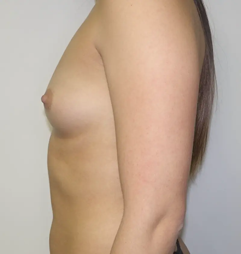 Before and after of breast augmentation side view