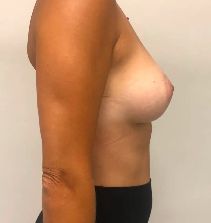 Before and after of breast augmentation side view