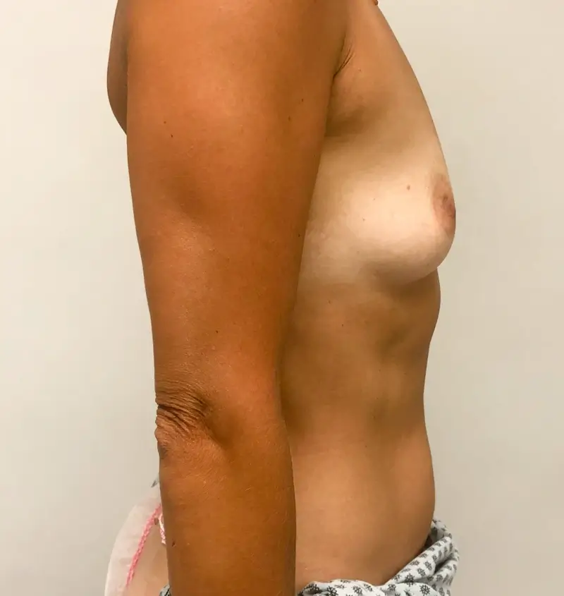 Before and after of breast augmentation side view