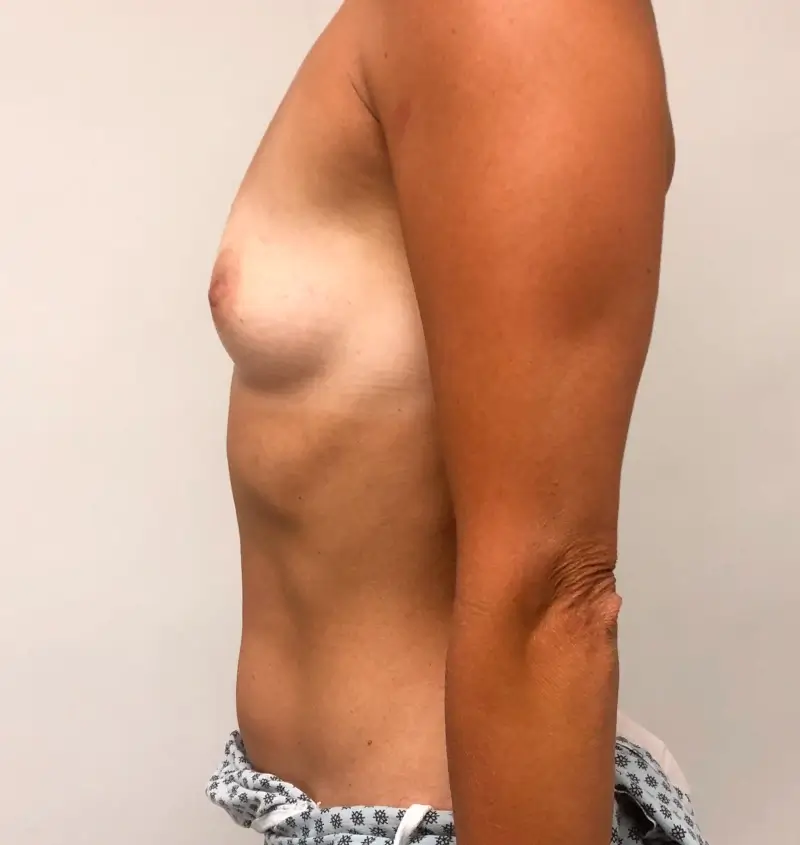 Before and after of breast augmentation side view