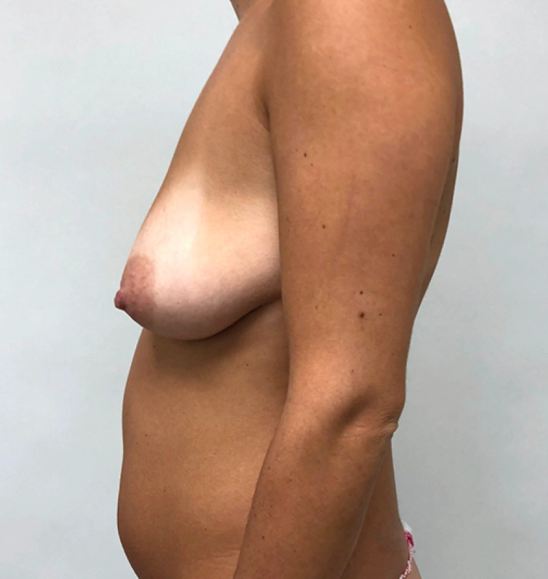 Breast augmentation and lift before and side front view
