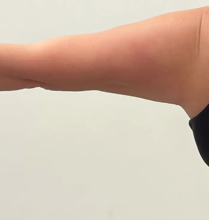 Arm lift before and after back image