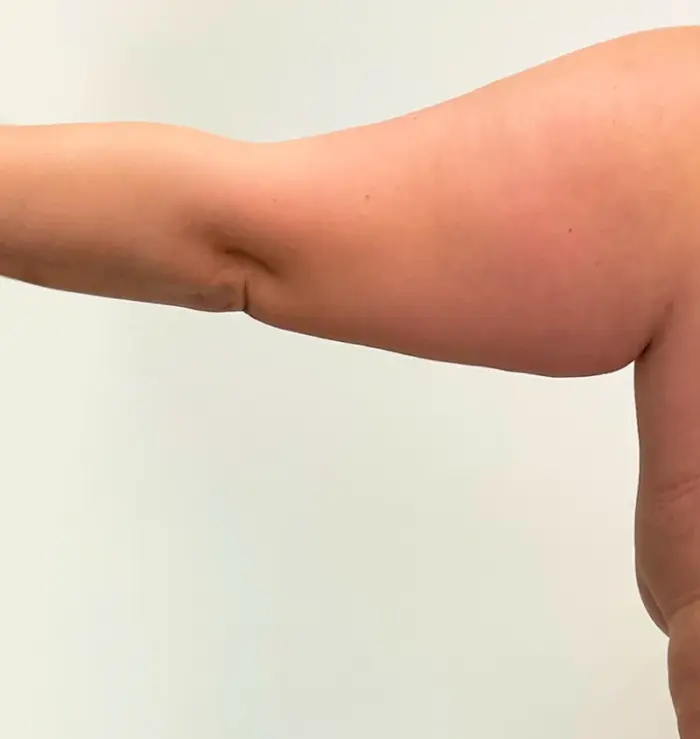 Arm lift before and after back image