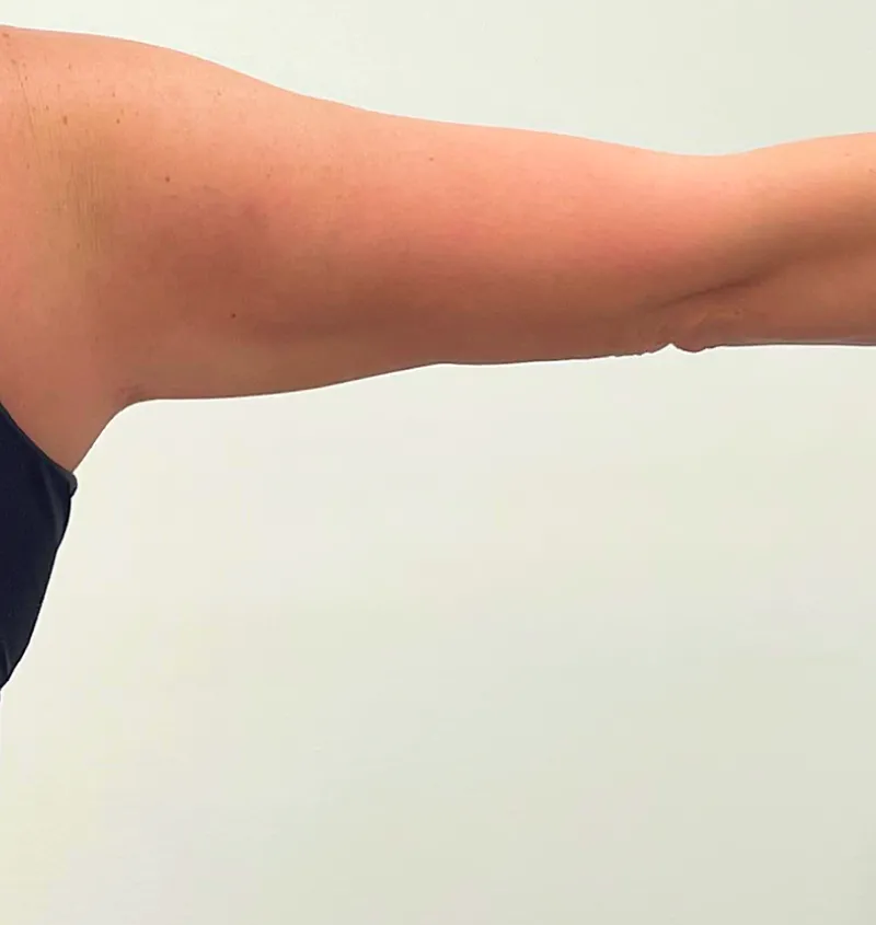 Arm lift before and after back image